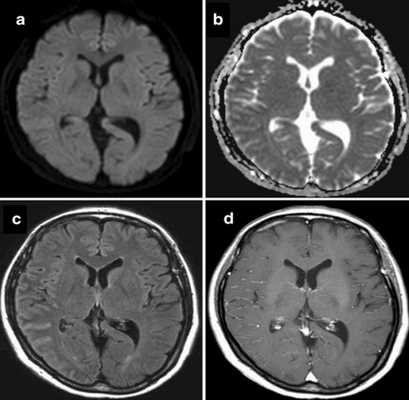 Ревматоидный менингит с инсультоподобными нарушениями на МРТ