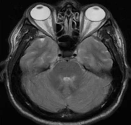 Криптококковый менингит на фоне ВИЧ-инфекции на МР-снимках