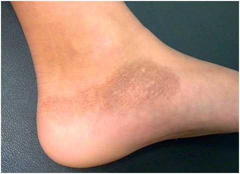 Глубокие пигментации - поствоспалительная гиперпигментация на ноге