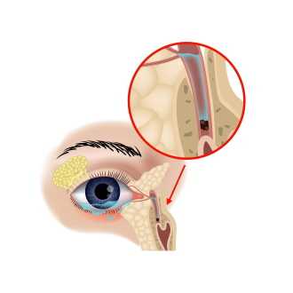 Непроходимость носослезного канала