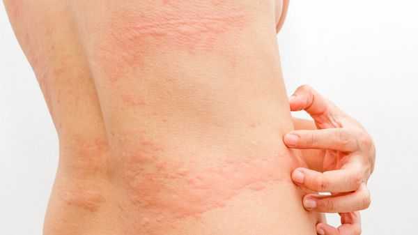 Крапивница