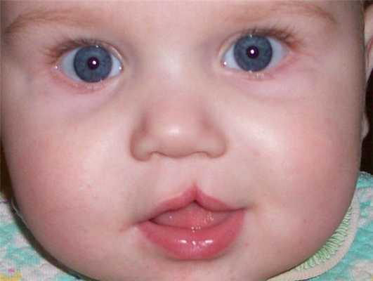 Расщелина губы