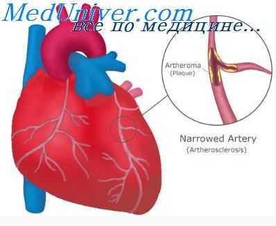 дефект межпредсердной перегородки