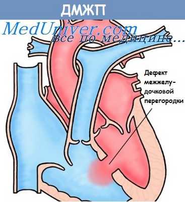 дефект перегородки у ребенка