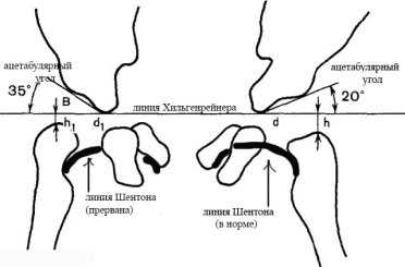C:\Users\Саша\Desktop\обучение 2017-2018\лучи\Хильгенрейнер1.jpg