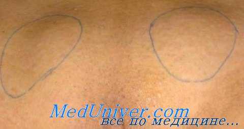 пуской псевдогермафродитизм