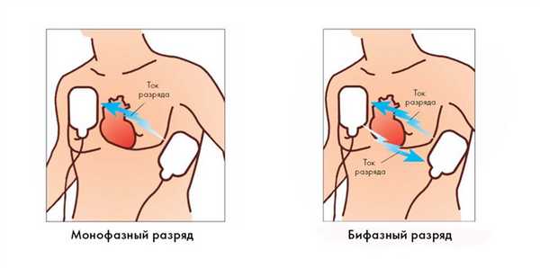 Монофазный и бифазный разряд