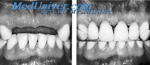 челюсть при ротовом дыхании