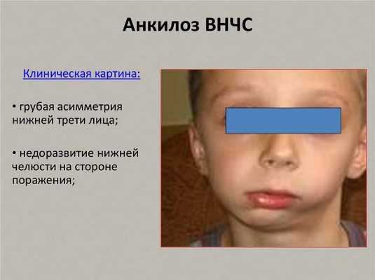 Операция на челюсть для исправления асимметрии лица