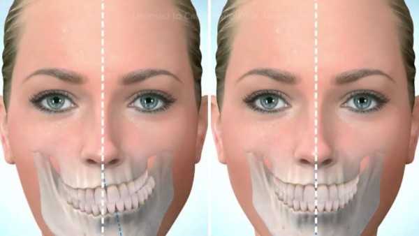 Исправление асимметрии челюсти у взрослых