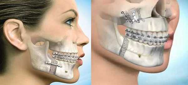 Исправление асимметрии челюсти