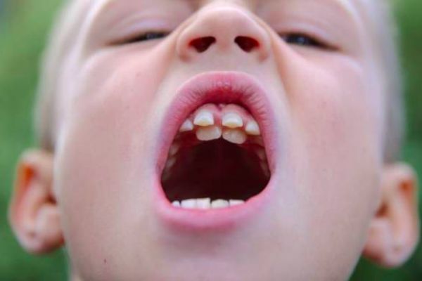 Аномалии зубов