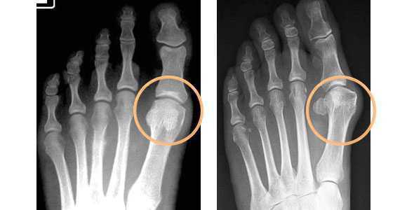 Рентгенография стопы (прямая проекция)