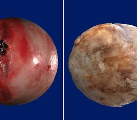 Деформирующий артроз тазобедренного сустава, лечение и профилактика