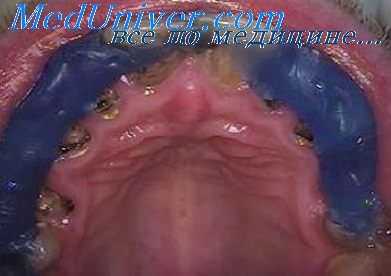 деформации челюсти при рахите