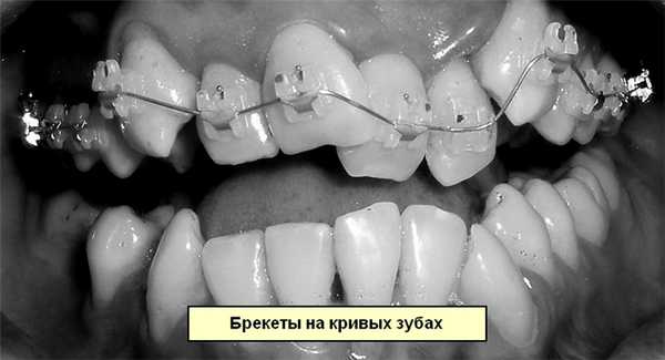 Пример брекетов