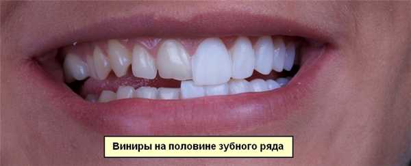 Виниры и люминары - простой способ получить голливудскую улыбку