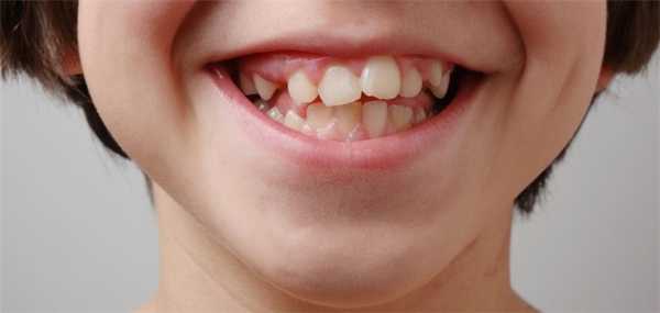 Кривые зубы