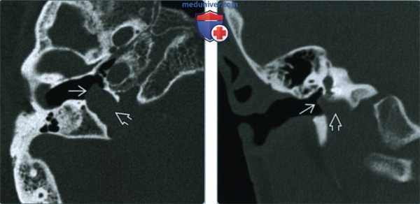 Дегисценция луковицы яремной вены - лучевая диагностика