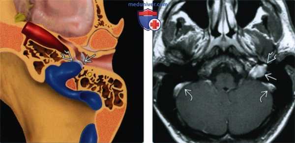 Дегисценция луковицы яремной вены - лучевая диагностика