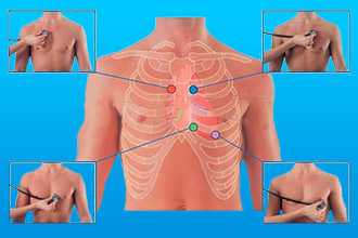 Аускультация