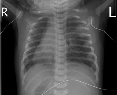 Декстрокардия на рентгене