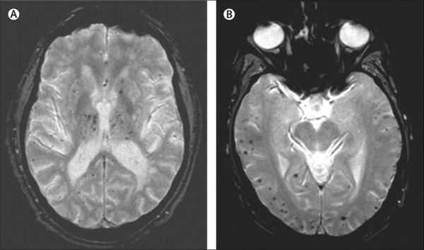 А. Дисциркуляторная энцефалопатия (подкорковые микрокровоизлияния) В. Болезнь Альцгеймера (корковые церебральные микрокровоизлияния)