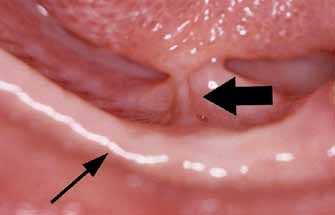 Анкилоглоссия