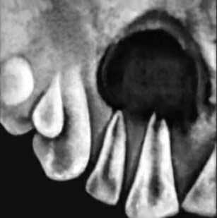 Радикулярная киста