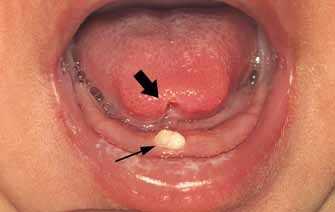 Врожденные и неонатальные зубы