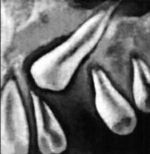 Фолликулярная киста