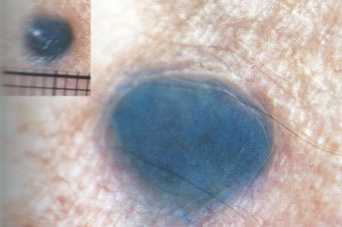 Опасная родинка