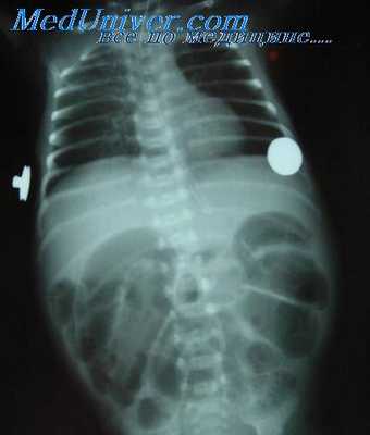 деформация пищевода