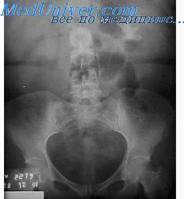 рентгенограмма