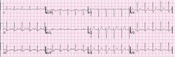 ЭКГ с волной предсердной реполяризации.