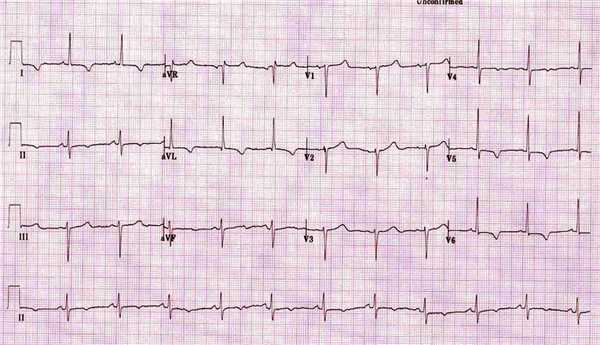 Отрицательные зубцы T при ишемии миокарда на ЭКГ.
