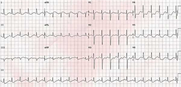 Ишемия миокарда на ЭКГ.