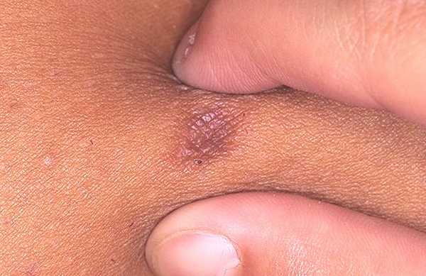 Дерматофиброма западающая.jpg