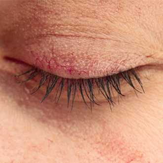 Дерматит век