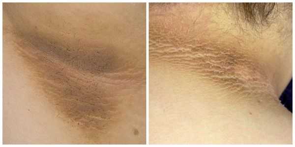 Чёрный акантоз