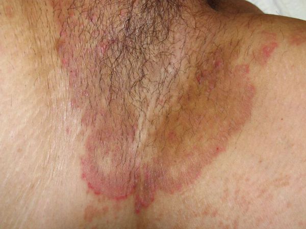 Кольцевидные очаги с периферическим отёчным валиком красного цвета [15]