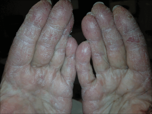 Дерматомиозит_руки.png
