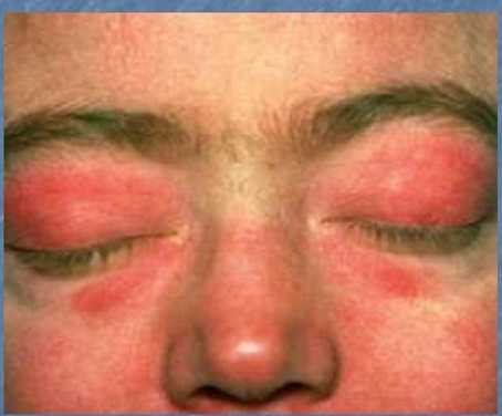 Дерматомиозитные очки.jpg