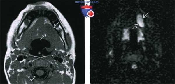 КТ, МРТ при дермоиде и эпидермоиде полости рта