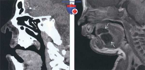 КТ, МРТ при дермоиде и эпидермоиде полости рта