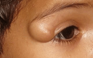 Дермоидная киста яичника