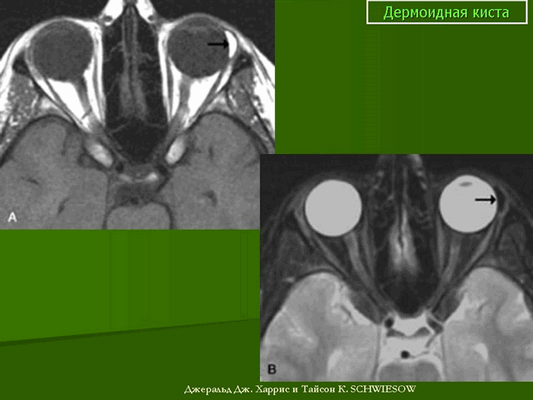 Дермоидная киста яичника
