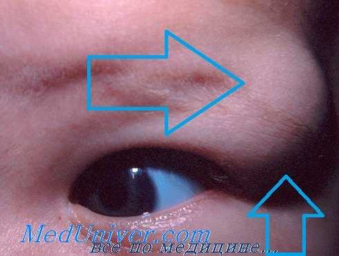 Дермоидная киста у ребенка