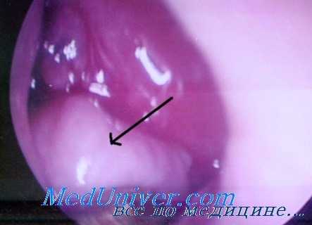 дермоидные кисты глаза