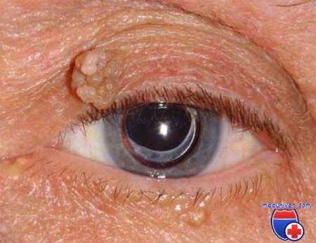 папилломы века глаза